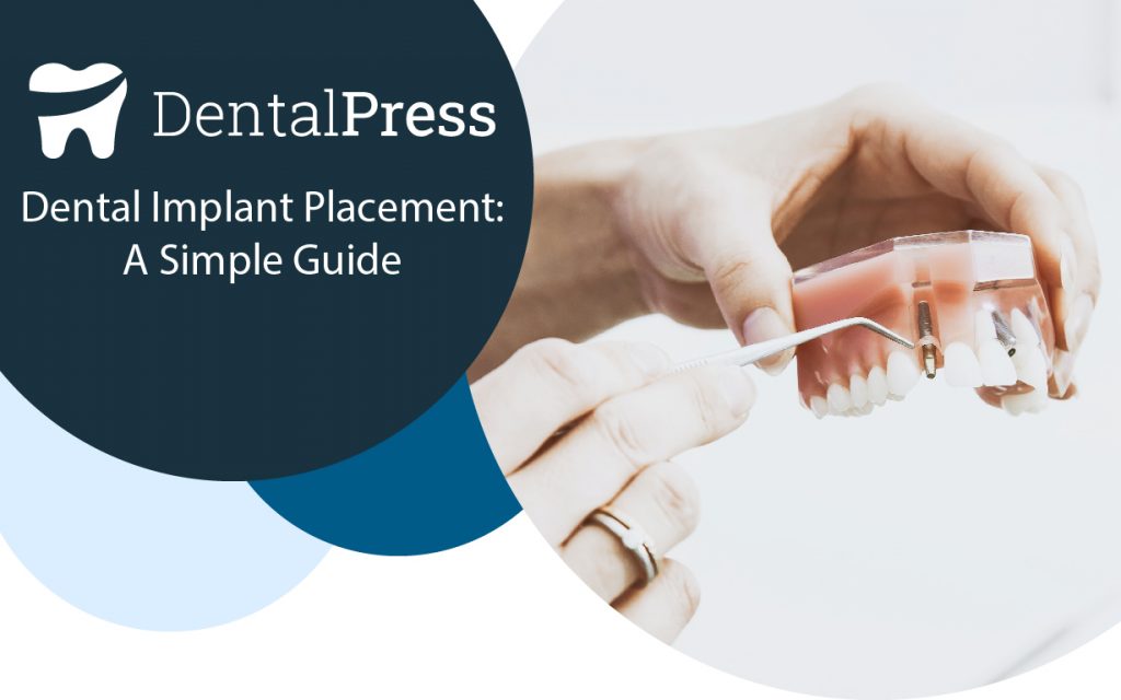 Dental Implant Placement: A Simple Guide