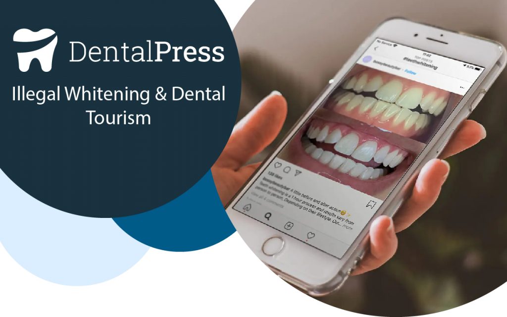 Illegal Whitening & Dental Tourism